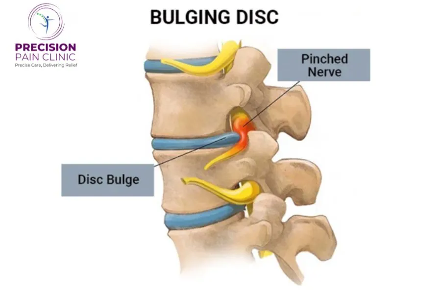 Cervical Epidural MIPSI (Non - Surgical Minimally Invasive Procedure for Neck Pain)